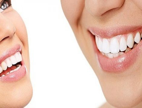 Woman focused on teeth cosmetic dentistry health insurance